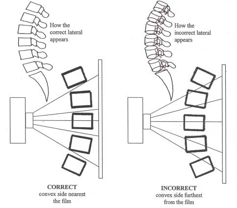 Scoliosis distortion diagram